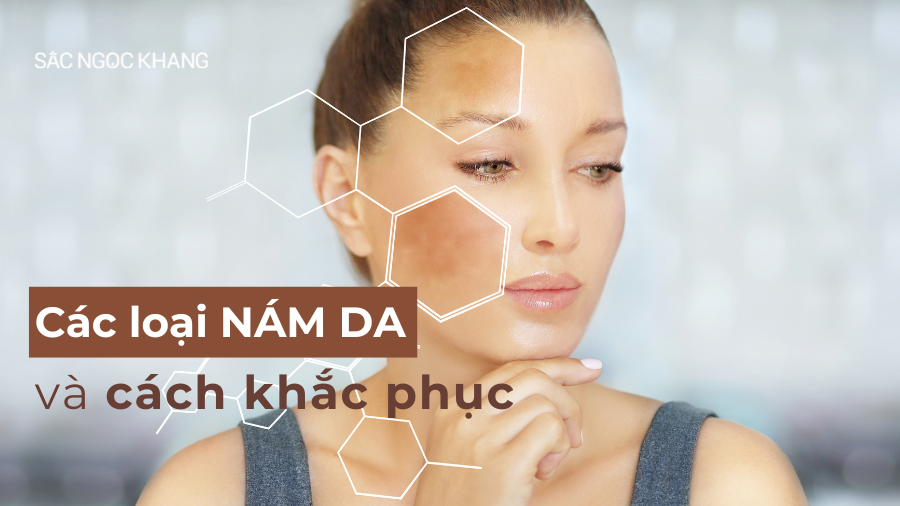 Các loại nám da và cách khắc phục hiệu quả 2024