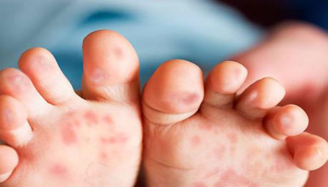 lòng bàn chân nổi chấm đỏ