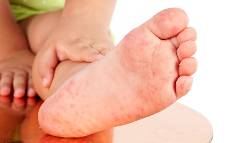 lòng bàn chân nổi chấm đỏ