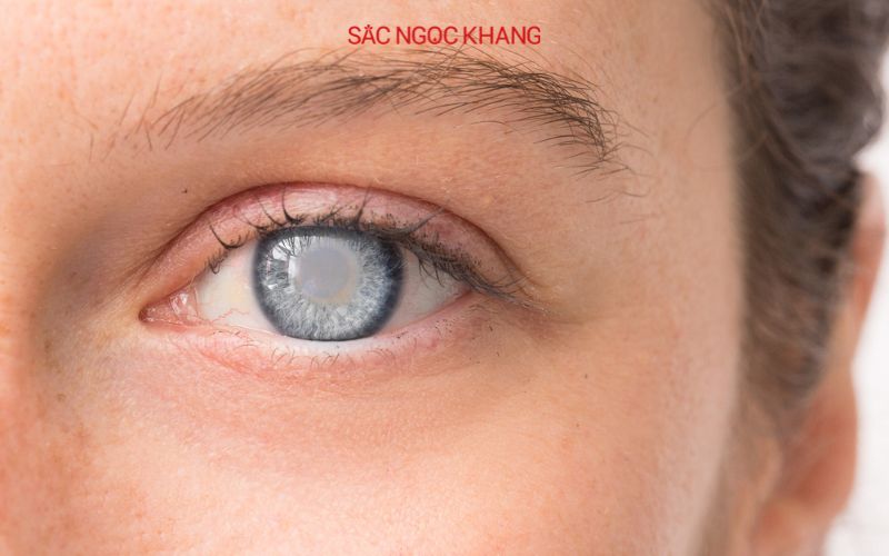 Bệnh đục thủy tinh thể