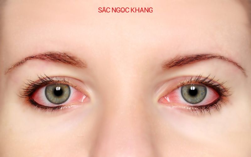 Bệnh đục thủy tinh thể