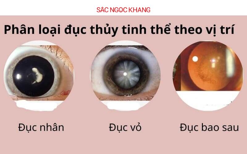 Bệnh đục thủy tinh thể