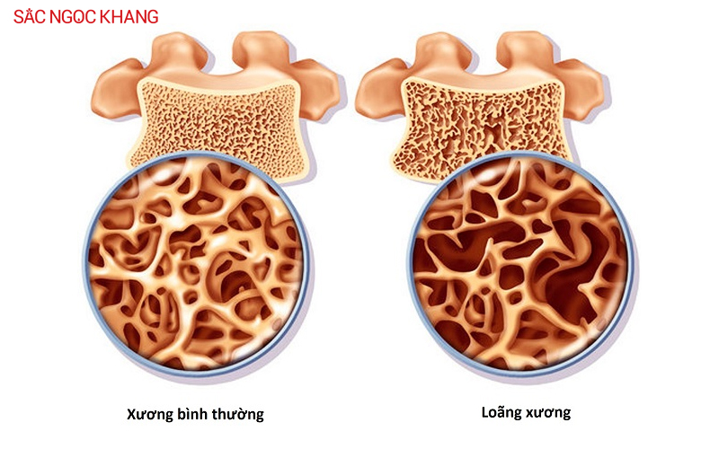 Bệnh loãng xương là gì