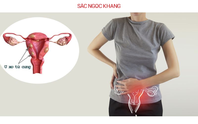Bị u xơ có uống được Collagen không