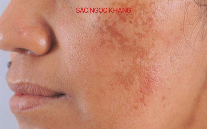 Nám mảng là loại nám phổ biến nhất