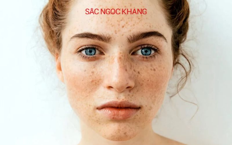 Ánh sáng xanh gây nám, sạm, tàn nhang