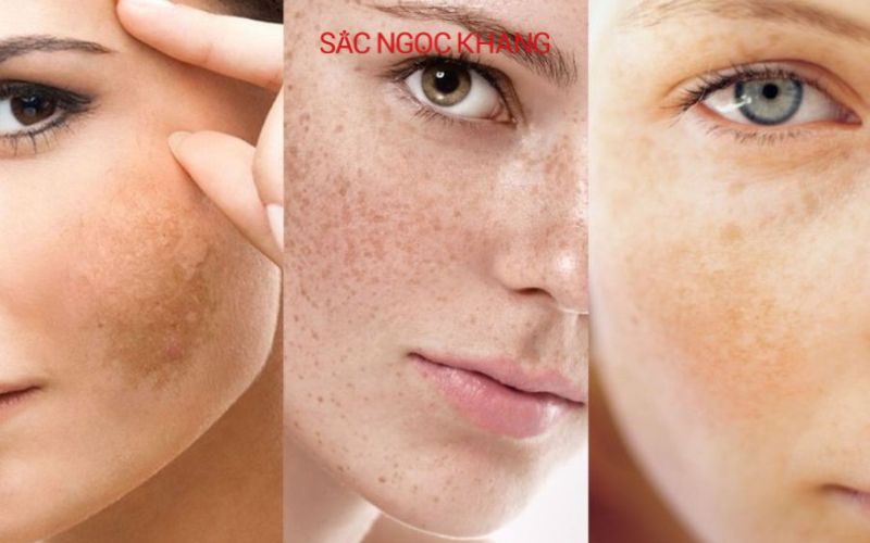 Nám hỗn hợp là sự kết hợp của các đốm nám và mảng nám