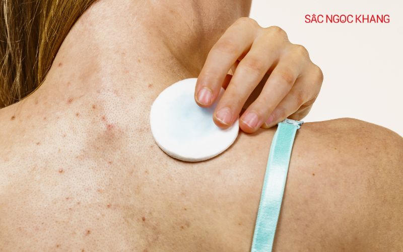 Chọn sữa tắm chứa các thành phần kháng khuẩn, trị mụn