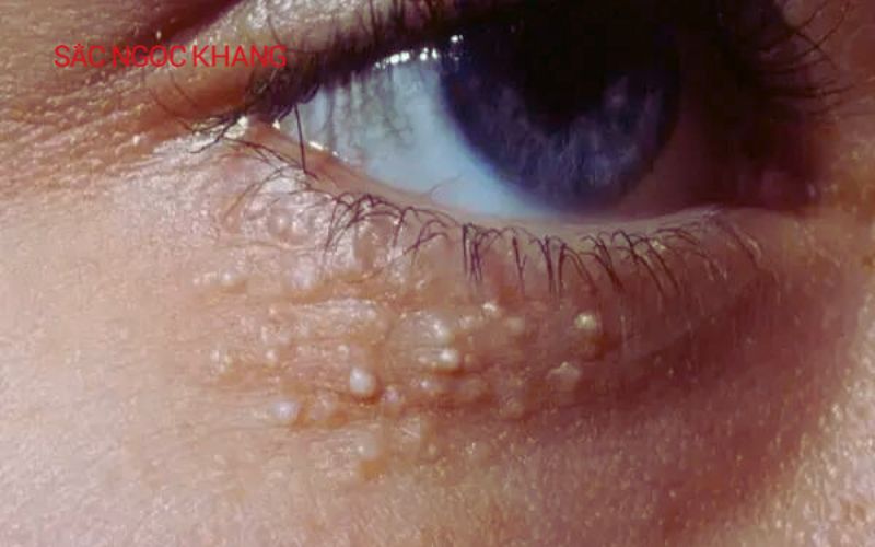 Cách lấy mụn gạo ở mắt