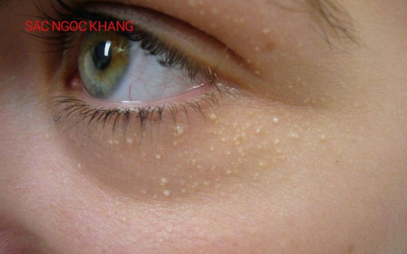 Cách lấy mụn gạo ở mắt