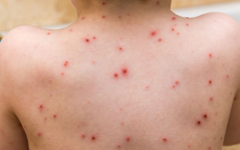 cây phèn đen chữa bệnh thủy đậu