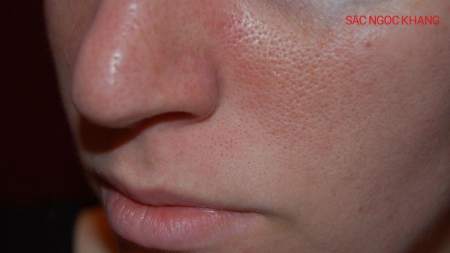 Ceramide giúp da duy trì độ ẩm lý tưởng, giảm nhu cầu tiết dầu quá mức