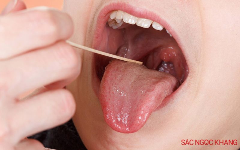 cổ họng lúc nào cũng có đờm là bệnh gì