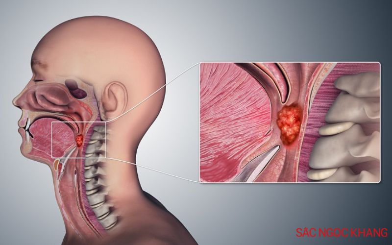 cổ họng lúc nào cũng có đờm là bệnh gì