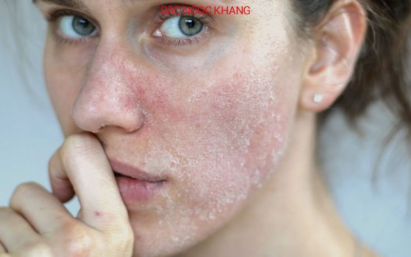 Da khô là tình trạng da bị thiếu độ ẩm da sần sùi, bong tróc