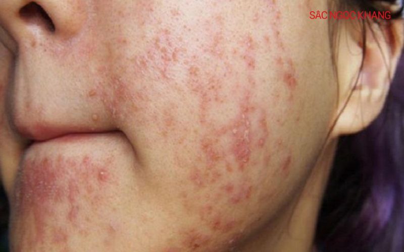 Da nhiễm corticoid bị tổn thương nghiêm trọng