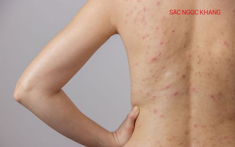 Viêm da cấp tính có thể gây đốm nâu trên cơ thể