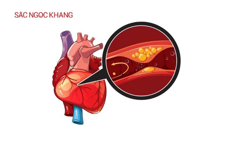 Đau tim khó thở