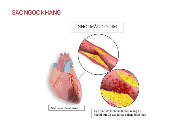 Đau tim khó thở