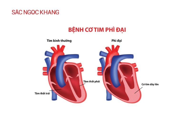 Đau tim khó thở