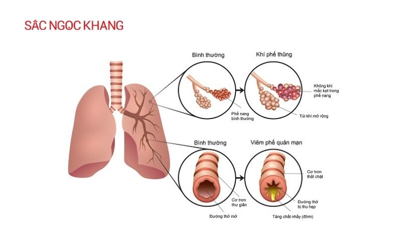 Đau tim khó thở