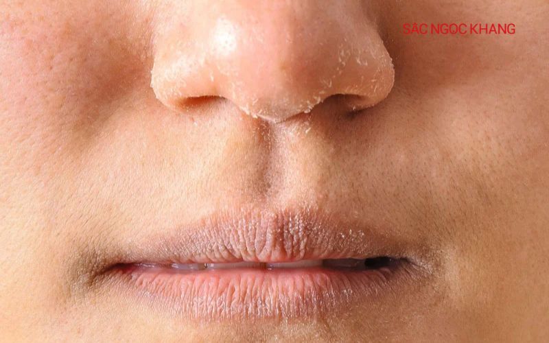 Tiền mãn kinh khiến da khô và mỏng hơn
