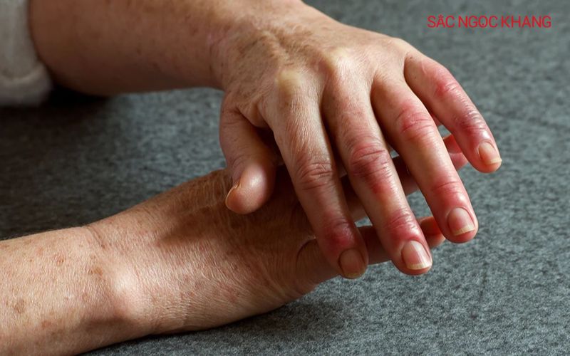 Tiếp xúc với nhiệt độ có thể khiến đầu ngón tay bị nóng rát