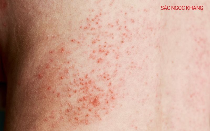 Một số người có thể bị phát ban khi sử dụng Glutathione