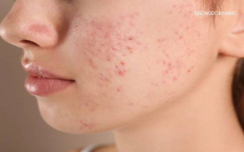 Hàng rào bảo vệ da bị tổn thương