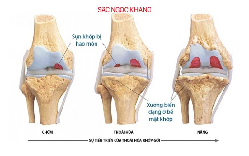 Bệnh viêm khớp