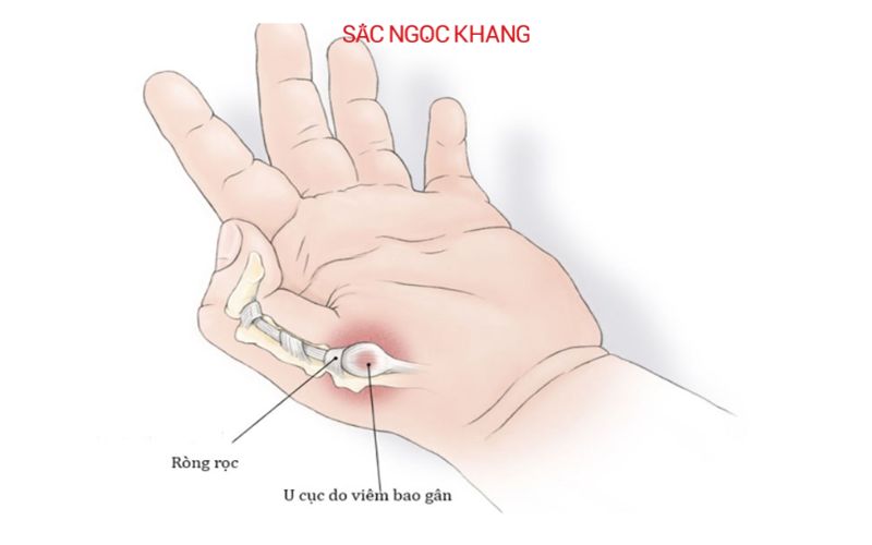 Bệnh viêm khớp ngón tay cái