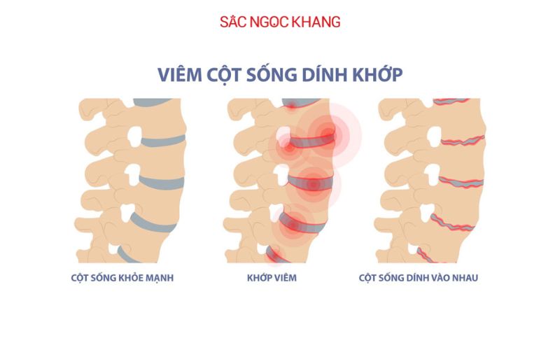 Bệnh viêm khớp