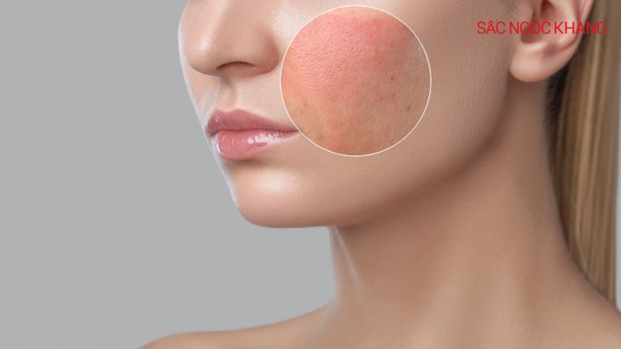 Kẽm oxit có tác dụng làm dịu da rất hiệu quả, đặc biệt là với làn da nhạy cảm