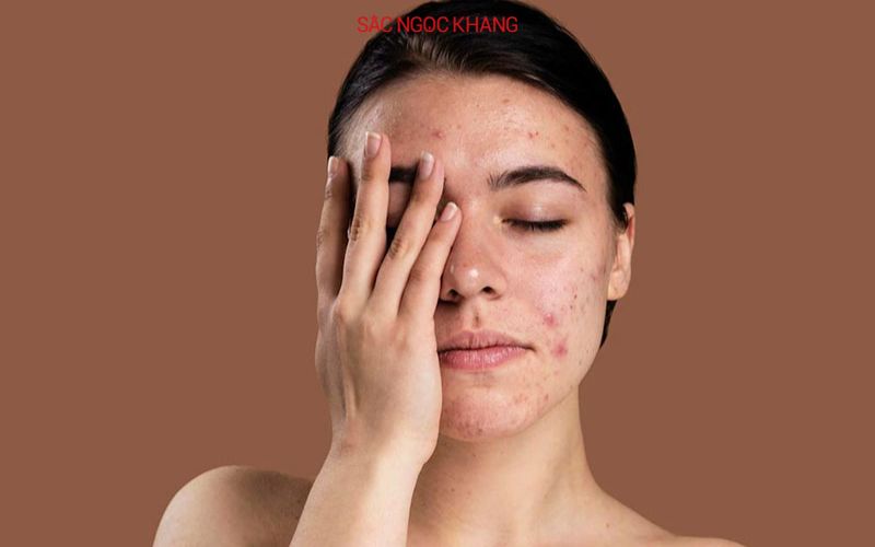 Nên chọn tẩy trang dạng nước cho da nhạy cảm