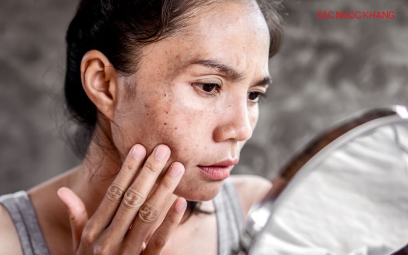 Nám da là một chứng rối loạn sắc tố da