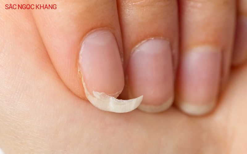 Móng tay giòn dễ gãy