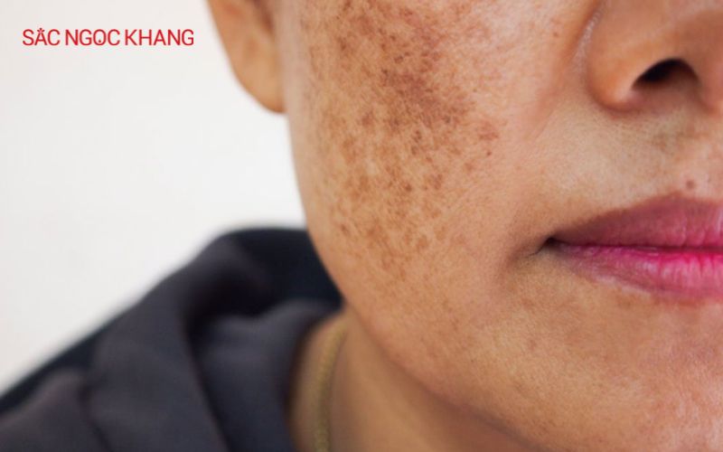 viên uống hỗ trợ trị nám chân sâu được tin dùng
