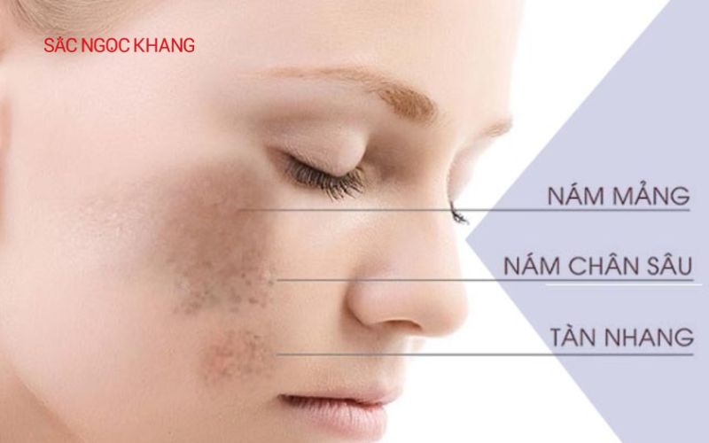 Nám nội tiết là gì