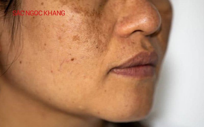Nám nội tiết là gì