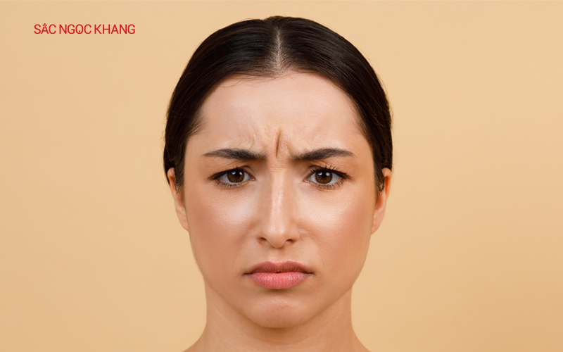 Nhíu mày liên tục gây nếp nhăn ấn đường