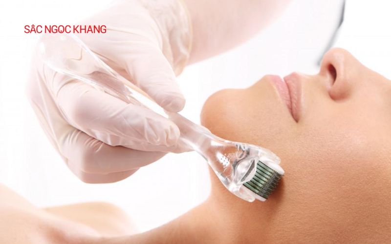 Lăn kim vi điểm (microneedling) kích thích tạo Collagen giảm nếp nhăn