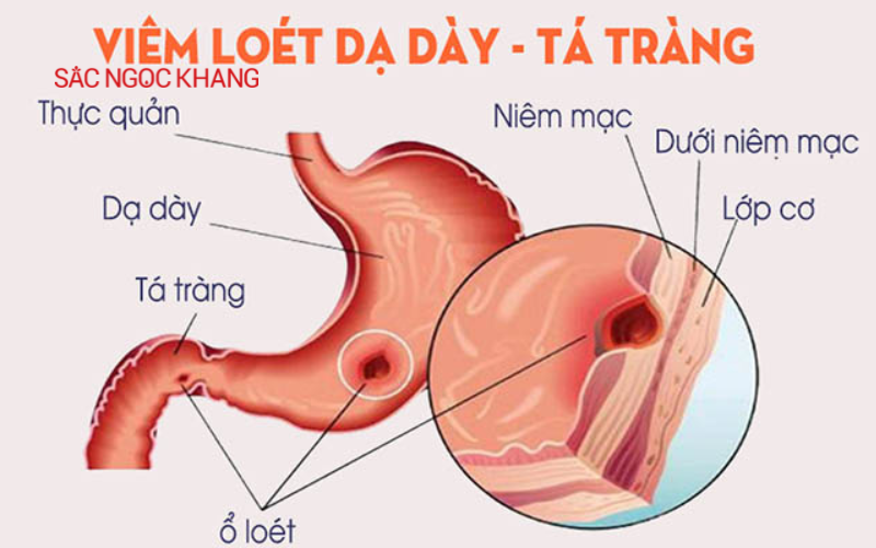 Bệnh viêm loét dạ dày