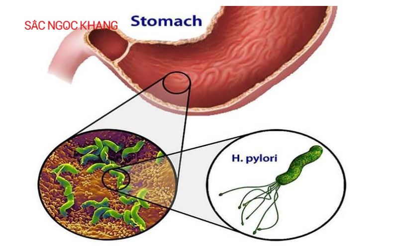 Bệnh viêm loét dạ dày