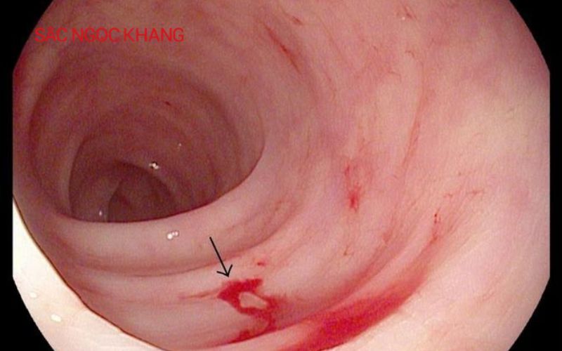 Bệnh viêm loét dạ dày