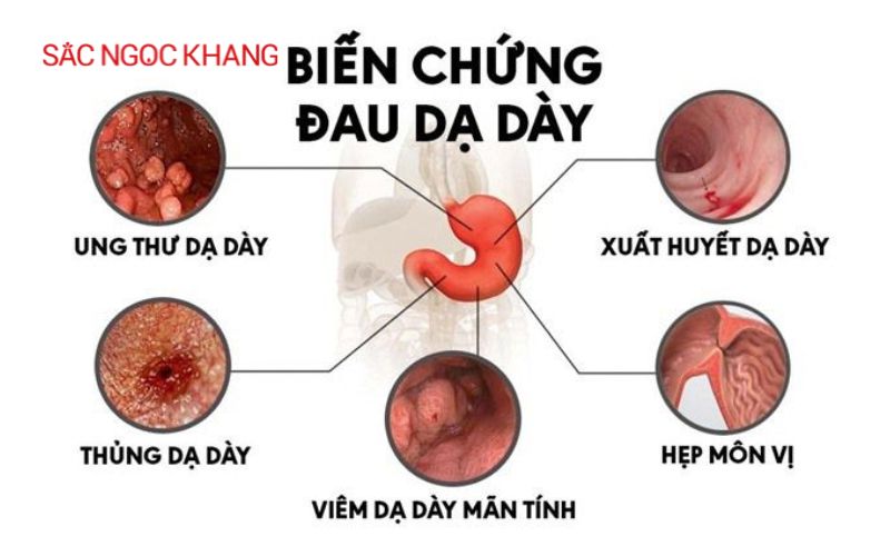 Bệnh viêm loét dạ dày