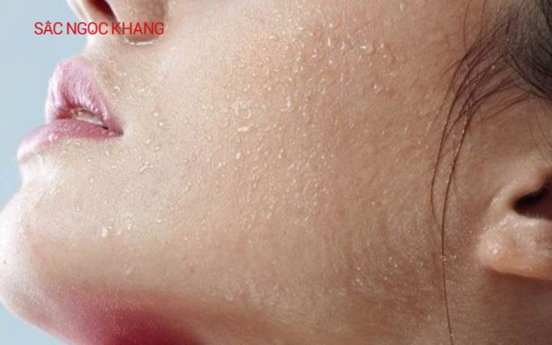 Thải độc da nhiễm corticoid