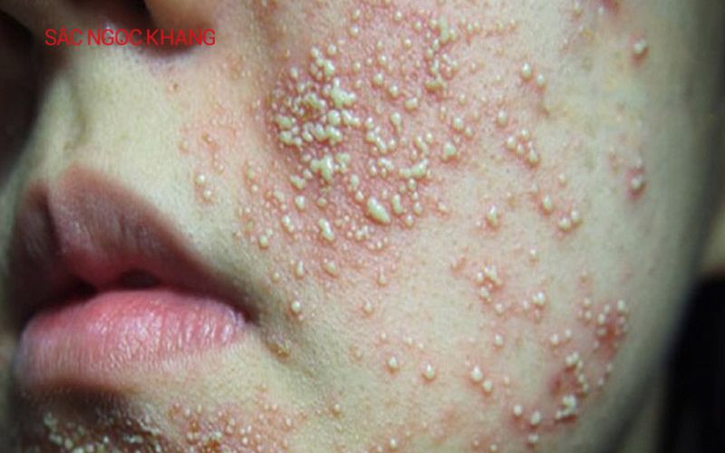 Thải độc da nhiễm corticoid