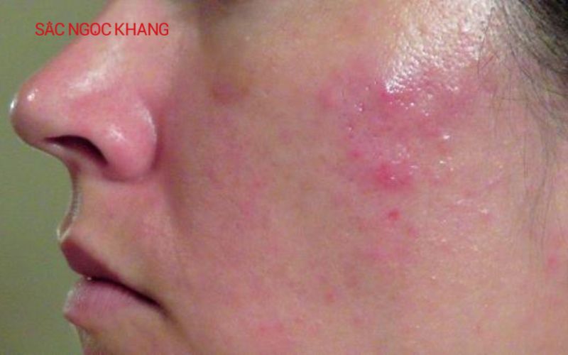 Thải độ da nhiễm corticoid