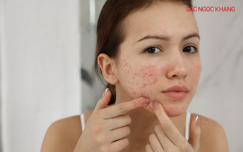 Không nên tẩy tế bào chết trên da đang bị mụn viêm