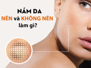 nám da do rối loạn nội tiết